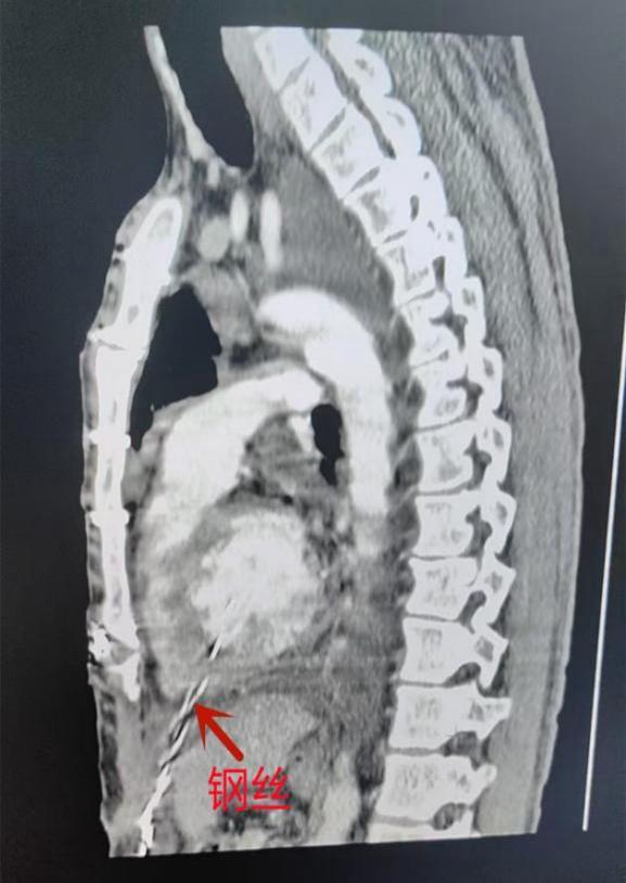 泽巨配资 男子被12厘米钢丝刺入心脏，没想到3年前手术后形成的“保护层”救了他